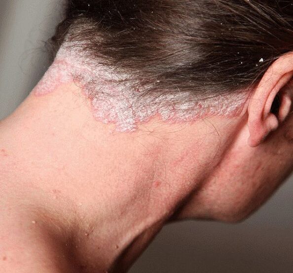 Cómo tratar la psoriasis