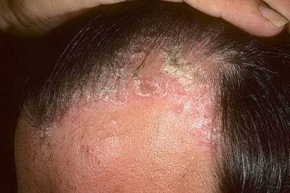 Síntomas de psoriasis