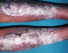 Pomada de la psoriasis