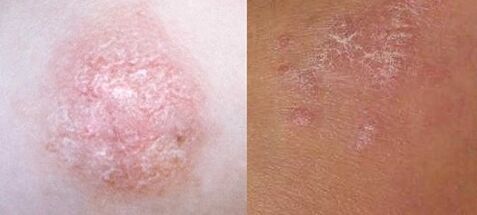 Psoriasis en las primeras etapas
